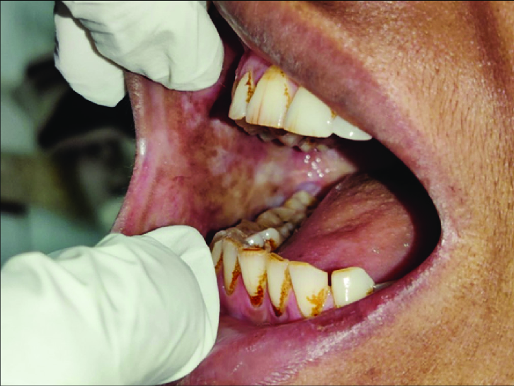 Oral Submucous Fibrosis (OSMF) Treatment