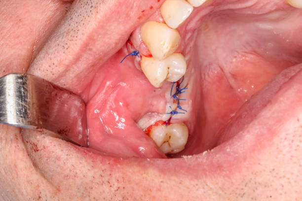 Treatment of Oral Lesions
